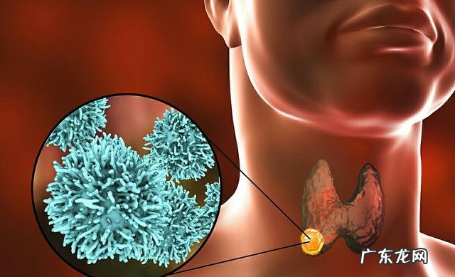 甲状腺癌成活率高吗能有百分之几死亡率?