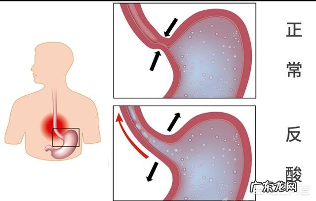 胃病一直反复,中药和西药也服用过,吃完东西胃反酸,怎么办好?