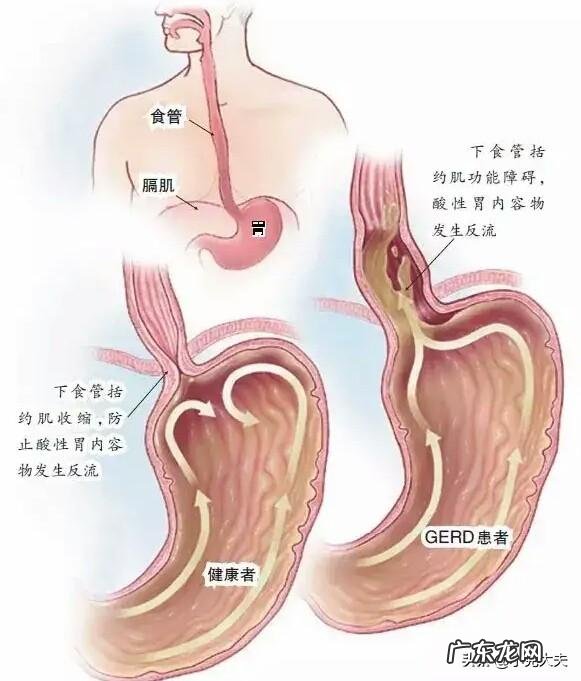 胃病一直反复,中药和西药也服用过,吃完东西胃反酸,怎么办好?