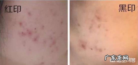 男生脸上有痘印痘坑,如何消除