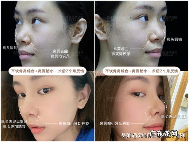 韩国隆鼻亲身经历 做隆鼻手术亲身经历