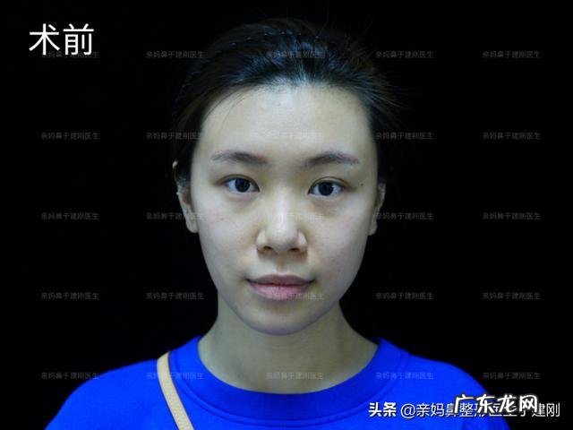 韩国隆鼻亲身经历 做隆鼻手术亲身经历