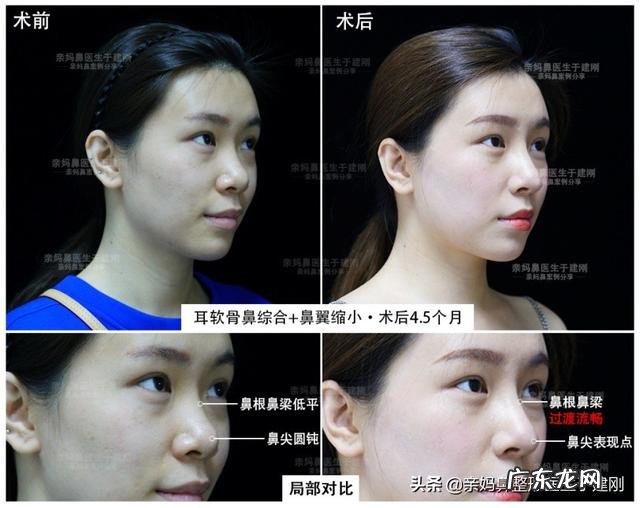 韩国隆鼻亲身经历 做隆鼻手术亲身经历