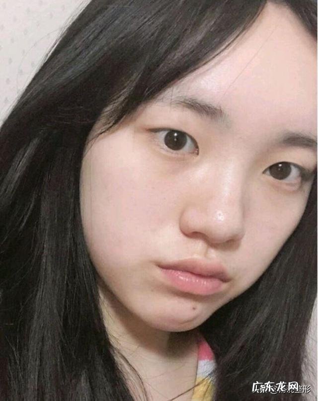 隆鼻鼻头多久恢复自然 隆鼻术后鼻头多久好看