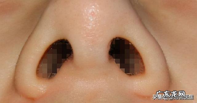 隆鼻后鼻头大怎么办 隆鼻鼻头太长怎么修复