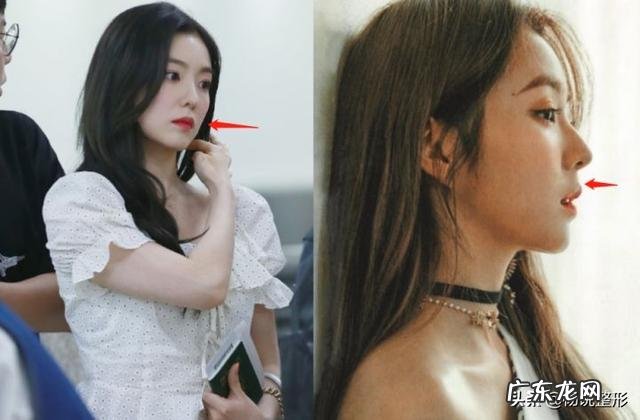 隆鼻后鼻头大怎么办 隆鼻鼻头太长怎么修复