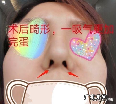 隆鼻后鼻头大怎么办 隆鼻鼻头太长怎么修复
