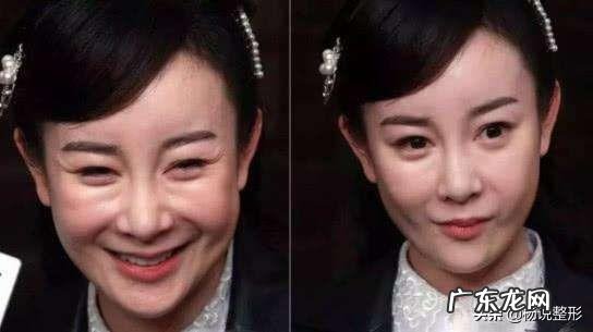 隆鼻后鼻头大怎么办 隆鼻鼻头太长怎么修复