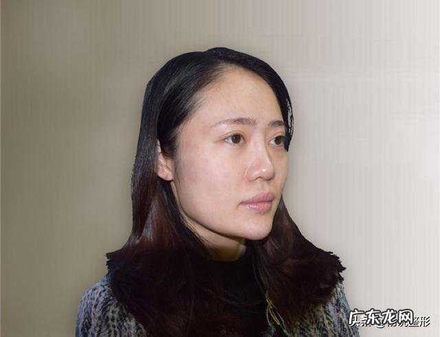 整形鼻子图片大全 鼻子整形怎么整的