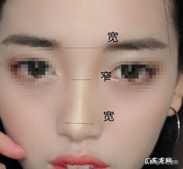 隆鼻的正确整形方法 整形隆鼻必备知识