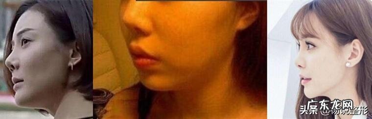 隆鼻的正确整形方法 整形隆鼻必备知识