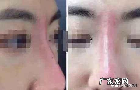 隆鼻的正确整形方法 整形隆鼻必备知识