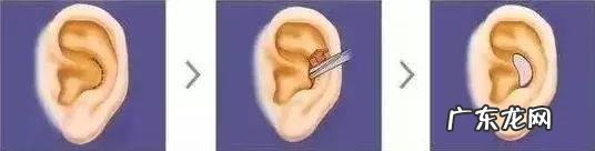 耳软骨隆鼻和鼻中隔哪个好 鼻中隔耳软骨隆鼻有哪些优缺点