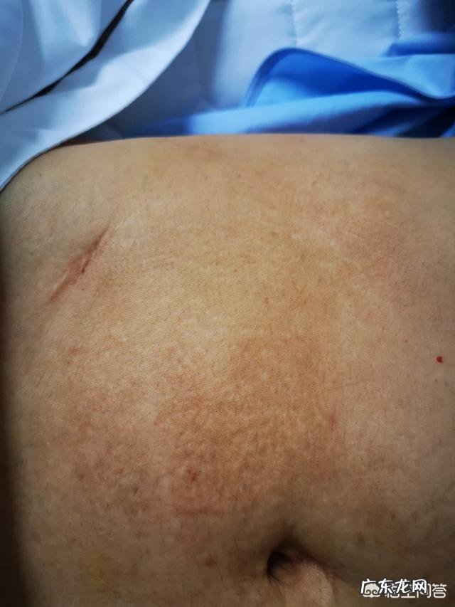 剖腹产后如何修复疤痕?如何健康瘦身?