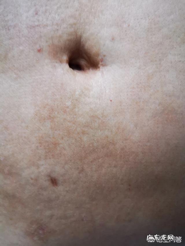 剖腹产后如何修复疤痕?如何健康瘦身?