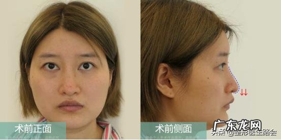 隆鼻后鼻背皮肤变薄怎么办 隆鼻鼻头变薄
