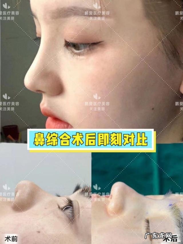 鼻综合整形的正确方式 鼻整形的基本步骤