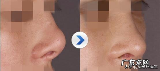 假体隆鼻后需不需要换假体 假体隆鼻歪了需要重新换假体吗