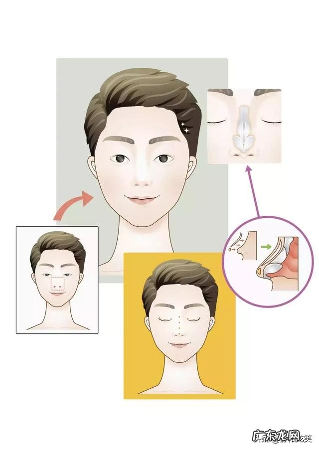隆鼻术小知识 隆鼻术全过程