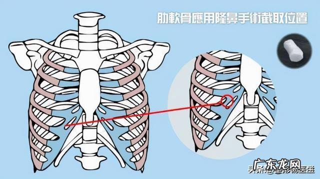 隆鼻后年纪大了会怎样 隆鼻老了以后怎么样