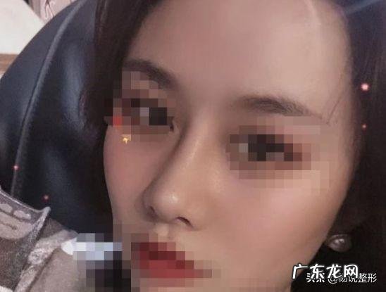 隆鼻后年纪大了会怎样 隆鼻老了以后怎么样