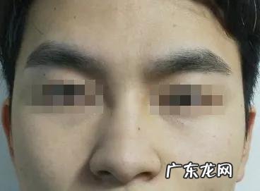 隆鼻方式有几种 隆鼻方式区别