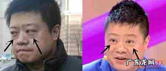 星动态:马东割眼袋对比还是没了眼袋好