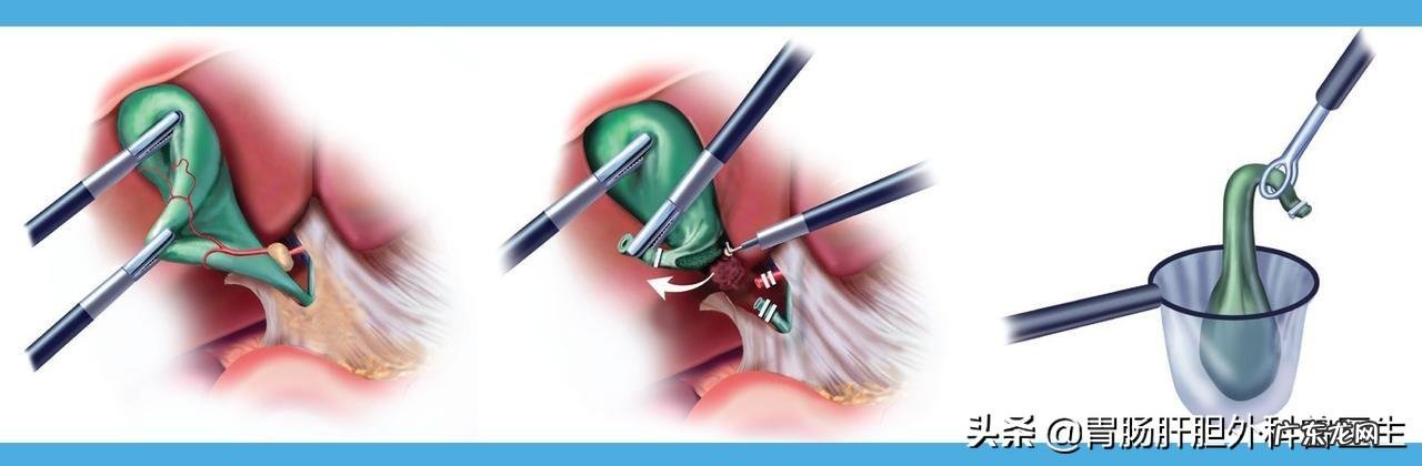 胆囊息肉是如何形成的?如何通过饮食让囊肉缩小消失?