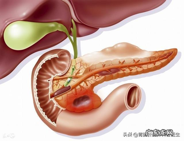 胆囊息肉是如何形成的?如何通过饮食让囊肉缩小消失?