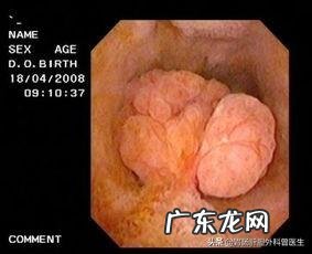 胆囊息肉是如何形成的?如何通过饮食让囊肉缩小消失?