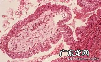 胆囊息肉是如何形成的?如何通过饮食让囊肉缩小消失?