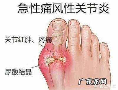 痛风多是“吃”出来的,医生说:3种食物是祸根,具体指什么