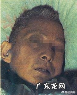 本人皮肤较黑,而且越来越黑,不恢复,谁有好的办法