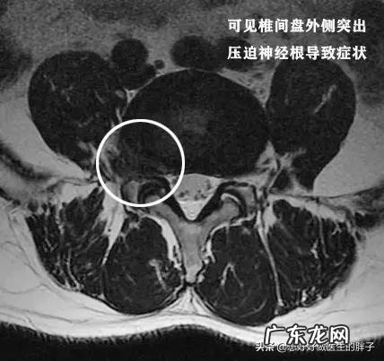 腰间盘突出髓核掉椎管里了怎么办?