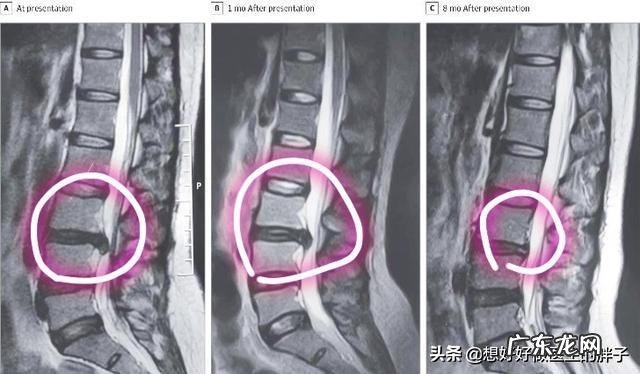 腰间盘突出髓核掉椎管里了怎么办?