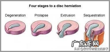 腰间盘突出髓核掉椎管里了怎么办?