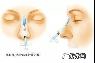 隆鼻都有什么样的鼻型图 隆鼻对自己的鼻型的看法