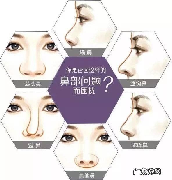 隆鼻大综合和小综合的区别 简单隆鼻和综合隆鼻的区别