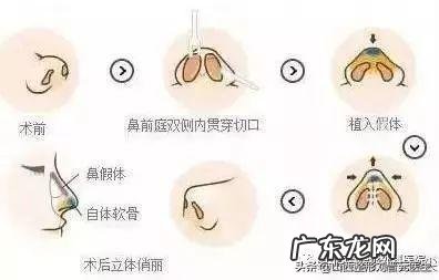关于隆鼻你最关心的几个问题 关于隆鼻你知道多少