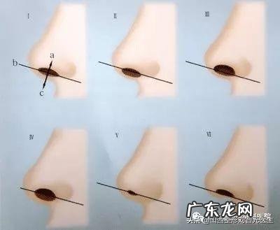 关于隆鼻你最关心的几个问题 关于隆鼻你知道多少