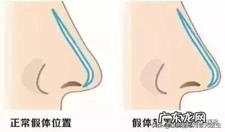 关于隆鼻你最关心的几个问题 关于隆鼻你知道多少