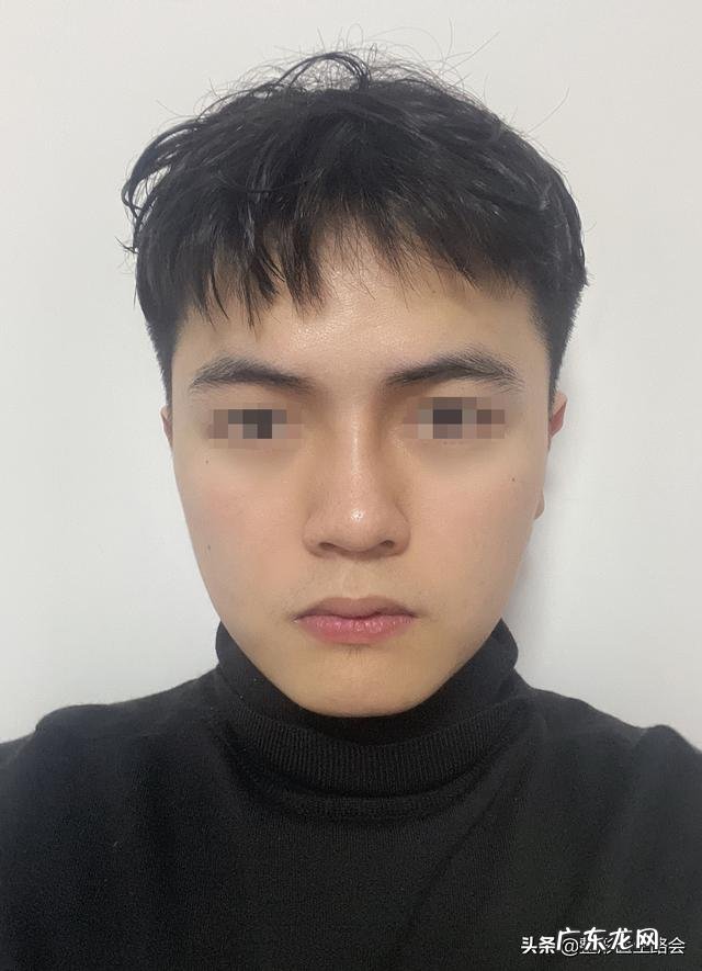 隆鼻修复真实案例 隆鼻真实恢复过程