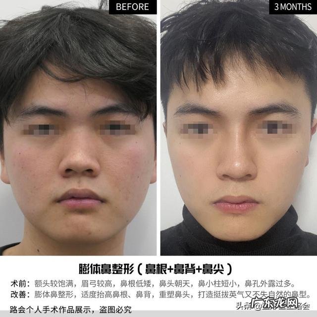 隆鼻修复真实案例 隆鼻真实恢复过程