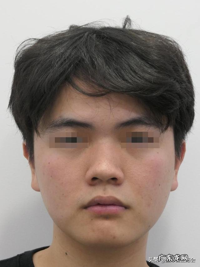 隆鼻修复真实案例 隆鼻真实恢复过程