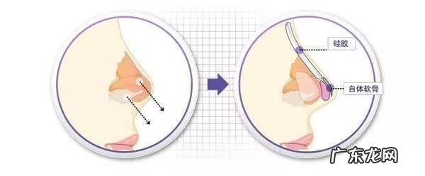 假体隆鼻后取出来能恢复吗 假体隆鼻取出后可以再继续隆鼻吗