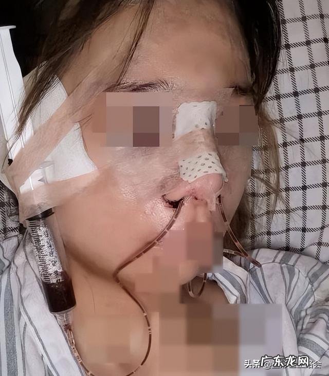 玻尿酸隆鼻可以坚持多久 隆鼻效果可以坚持多久