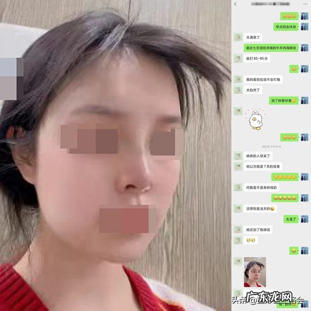 玻尿酸隆鼻可以坚持多久 隆鼻效果可以坚持多久