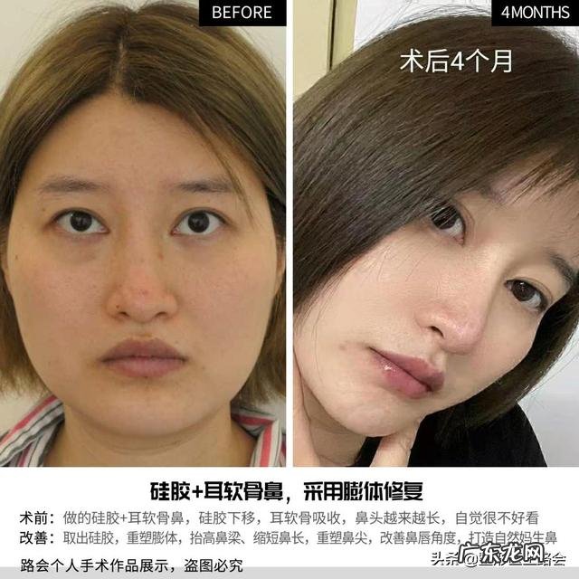 玻尿酸隆鼻可以坚持多久 隆鼻效果可以坚持多久