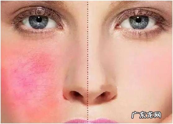 皮肤比较干用什么化妆品?长痘痘,敏感?