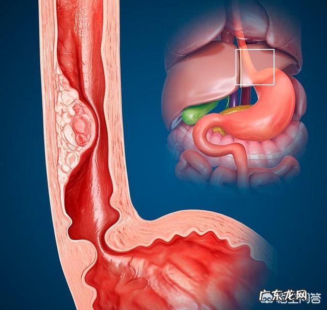 胃镜检查有散在颗粒增生,和不典型增生有什么不同?